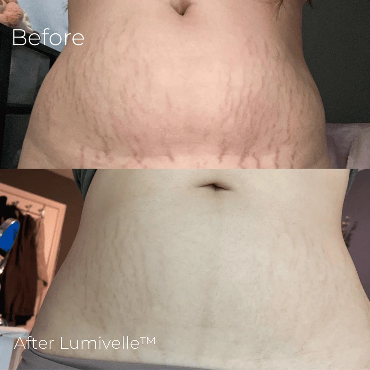 Lumivelle™ Micro-Infusion Skin Renewal System